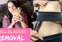 Vlog: What to Expect The 1st Week After Gallbladder Removal Surgery | What I Ate | Scars